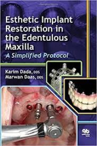 Esthetic Implant Restoration in the Edentulous Maxilla