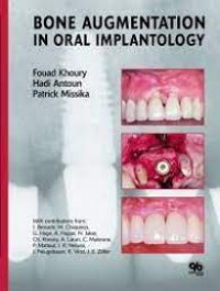 Bone Augmentation in Oral Implantology